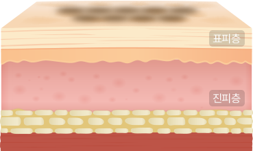 표피색소