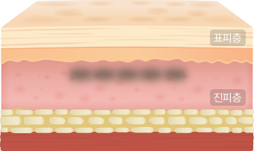 진피색소