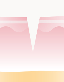 얼음송곳형 모양