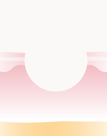 둥근접시형모양